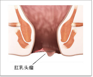 福州人肛乳头肥大去哪家医院看好